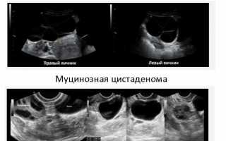 Цистаденома яичника: причины, лечение