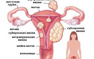 Как распознать признаки миомы матки