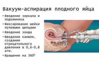 Вероятность бесплодия после аборта