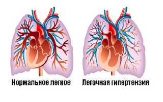 Новые стратегии лечения легочной гипертензии для пациентов неподдающихся традиционной терапии