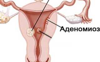 Женские заболевания при климаксе