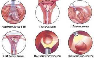 Лечение полипа на яичнике