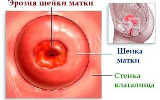 Лечение эрозии шейки матки свечами