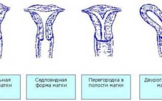 Седловидная матка — специфика атомической особенности