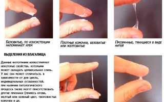 Молочно-белые вагинальные выделения: возможные причины и что делать
