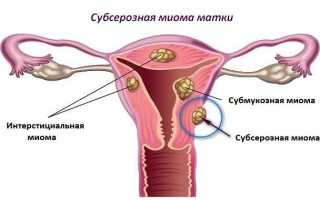 Лечение при субсерозном узле в матке