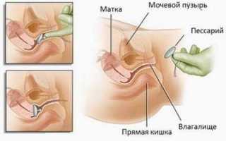 Кольца при опущении матки
