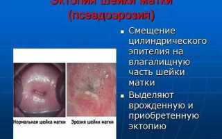 Маленькая эрозия шейки матки