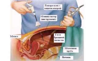 Экстирпация матки лапароскопическим методом