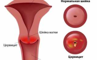 Как лечить цервицит