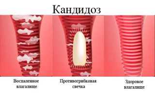 Как лечить вагинальный кандидоз у женщин