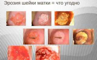 Какие осложнения бывают после прижигания эрозии у женщин