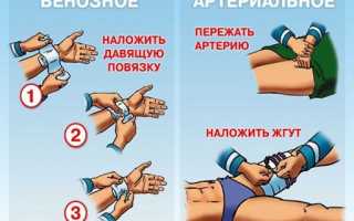 Кровотечение — утечка крови из организма при повреждении кровеносного сосуда