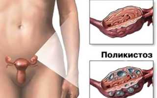 Как забеременеть при поликистозе яичников