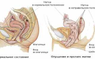 Последствия опущения матки у женщин