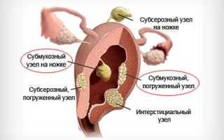 Лечение множественной миомы матки