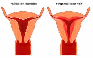 Гиперплазия эндометрия