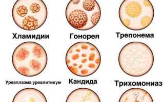Зуд и желтых выделения: 3 распространенных венерических заболевания, которые могут вызвать его