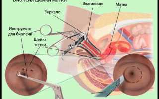 Как понять, что начался остеопороз при климаксе