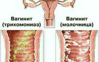 Помогает ли от молочницы Трихопол