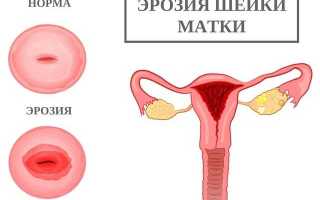 Дисплазия 2 степени