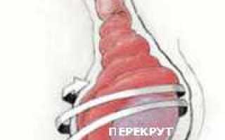 Особенности миомы матки на ножке