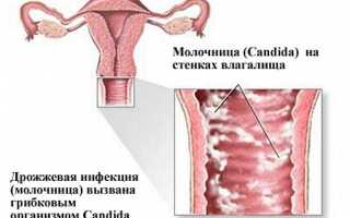 Может ли молочница повлиять на месячные