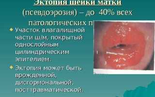 Эрозия шейки матки в гинекологии