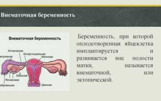 Бесплодие трубно-перитонеального генеза
