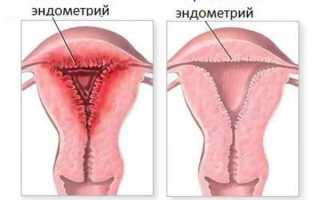Можно ли забеременеть после аборта и как правильно спланировать зачатие