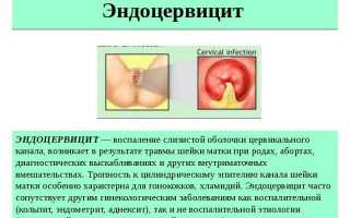 Лечение эндоцервицита шейки матки