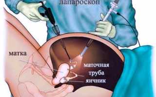 Лапароскопия яичников (удаление кисты)