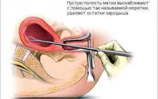Боли в матке после выскабливания