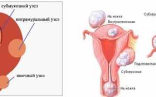 Узелки в матке