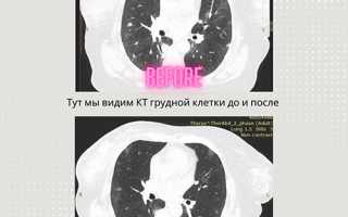 Трижды негативный рак молочной железы