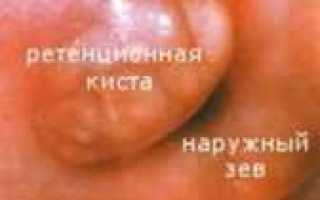 Лечение кисты на шейке матки