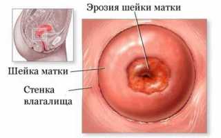 Как выглядит эрозия