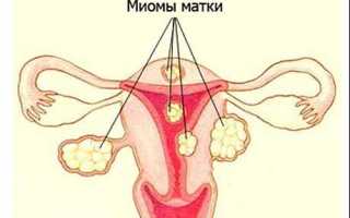Лечение фиброматоза матки