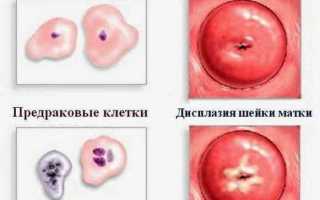 Кандистон и Эпиген спрей от молочницы