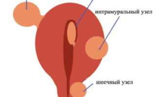 Может ли быть температура при миоме матки