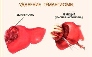 Гемангиома печени