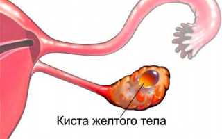 Что делать при кисте яичника в менопаузе
