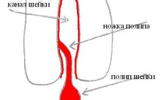 Запор во время месячных