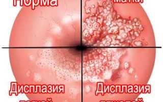 Легкая и тяжелая дисплазия шейки матки