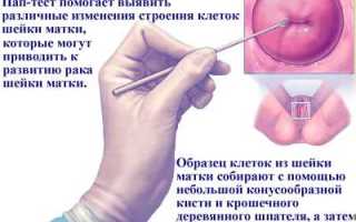 Расшифровка онкоцитологии шейки матки
