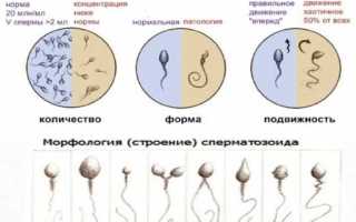 Идиопатическое бесплодие