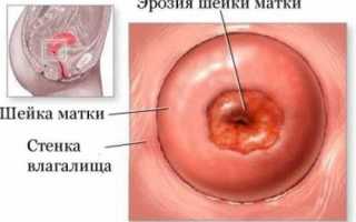 Прижигание шейки матки при эрозии
