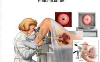 Лазерокоагуляция шейки матки