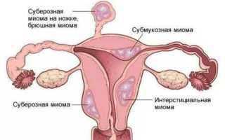 Продолжительность жизни при раке шейки матки