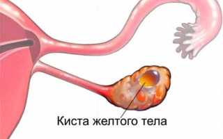 Разрыв кисты яичника